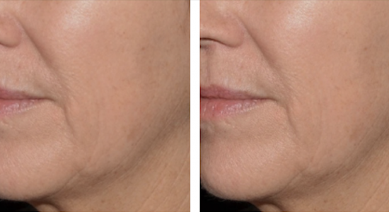 LaseMD Before/After