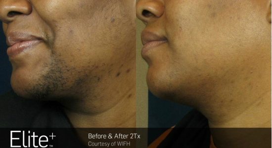 laser hair removal example